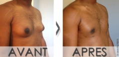 Ex-Homme-Gynecomastie